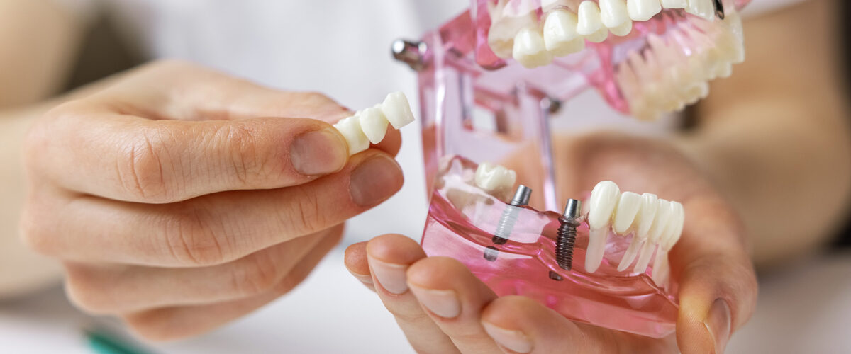 dentalbridges_banner